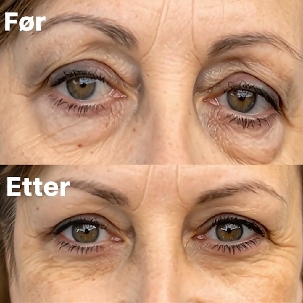 Eye Bag Red Light Therapy
